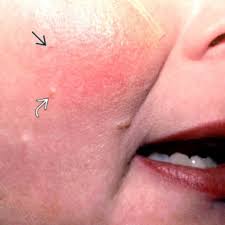 Palmar erythema is a type of skin problem that is only limited at the palms but this incident can also mean that there might be other. Face Erythema An Overview Sciencedirect Topics