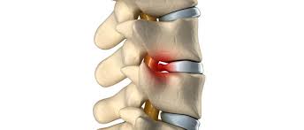 relieving pain from herniated discs