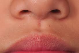 photograph of the patient s upper lip