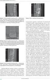 Zapalenie krążka międzykręgowego oraz trzonów kręgów opis przypadku - PDF  Darmowe pobieranie