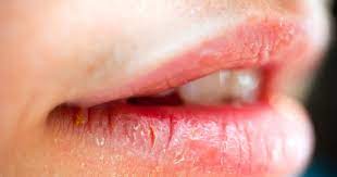 what is a lip sore blister on lip