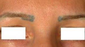 eyebrow laser tattoo removal