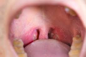 white spot on tonsils causes how to