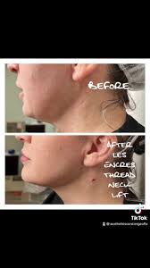 Feeling the effects of gravity? Book a Les Encres Thread lift! Our  experienced Nurse Practitoners come to you in the comfort of your own home  in the DFW...