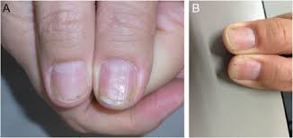nail psoriasis clinical features