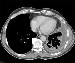 A conclusive diagnosis can only be made if the material is representative of the tumour with sufficient quantity to allow ihc and fish analysis characterisation in the context of. Ct Scanning Not Reliable For Correct Diagnosis Of Pleural Mesothelioma