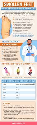 17 home remes for swollen feet