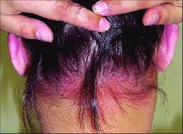 rash on the scalp acute allergic