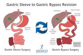 gastric sleeve revision surgery