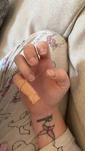 devon woman 28 loses fingernails