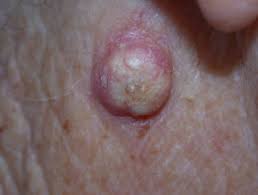 Skin cancer is actually one of the easiest cancers to find. Keratoacanthoma Dermnet Nz