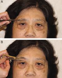 aging asian blepharoplasty