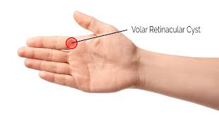 volar retinacular cysts wrist