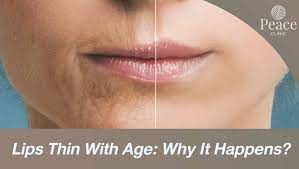 why do lips thin with age peace clinic
