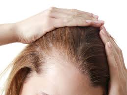 prp therapy hair restoration toronto