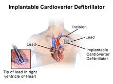 Icd 10 pacemaker placement codesall software. Implantable Cardioverter Defibrillator Wikipedia