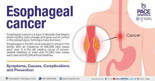 esophageal cancer symptoms causes