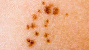 Nevus Definition Common Types Photos Diagnosis And