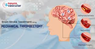 brain stroke treatment using mechanical