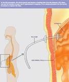 Image result for icd 10 code for feeding tube dysfunction