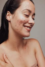 close up of smiling woman with acne and