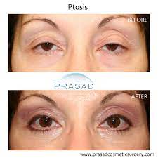 ptosis surgery before and after types