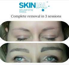 The good thing is that an eyebrow tattoo is tiny, and each treatment session may only last a minute. Non Laser Permanent Makeup Removal Skin Deep Clinic