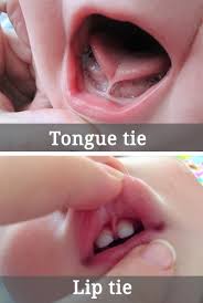 laser tongue tie procedure hoffman