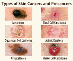 Fortunately, skin cancer is usually successfully treated when it's found in its early stages. Identifying Skin Cancer Samaritan Health Services