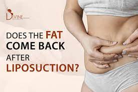 fat come back after liposuction tips