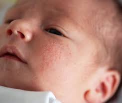 types of baby rashes