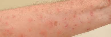 scabies control how to get rid of scabies
