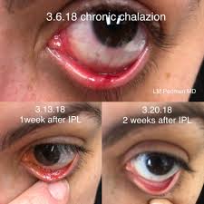 stye chalazion treatment dry eye