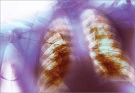 What are the early signs of respiratory distress? Autopsy In Ards Insights Into Natural History The Lancet Respiratory Medicine
