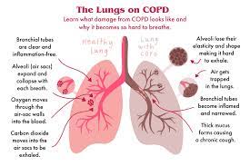 Copd stands for chronic obstructive pulmonary disease. Copd Here S Exactly How It Affects Your Lungs
