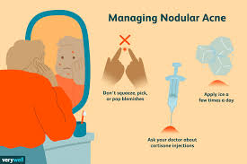 nodular acne signs does it go away