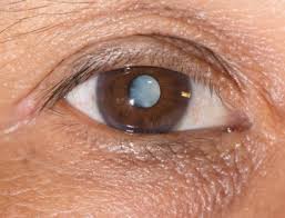 cataracts causes symptoms and
