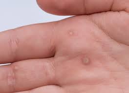 skin warts treatment dermatologist