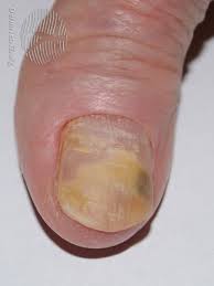causes of a loose toenail or fingernail