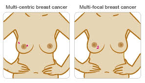 Cancer Grade And Size Breast Cancer Now