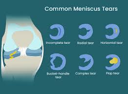 meniscus tear specialists in nj nyc