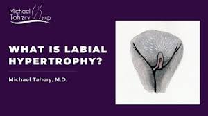 what is l hypertrophy dr