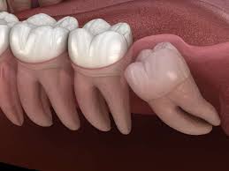 wisdom teeth removal what to expect
