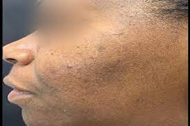 post inflammatory hyperpigmentation