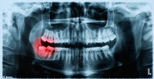 wisdom teeth extraction cambridge
