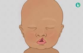cleft lip and cleft palate types