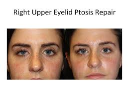 eyelid ptosis treatment austin