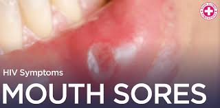 hiv mouth sores singapore hiv mouth