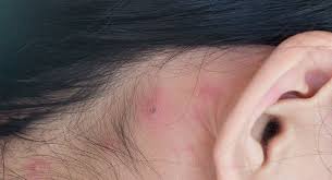 treat pimples behind the ears