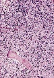 Acute Megakaryoblastic Leukemia Wikipedia